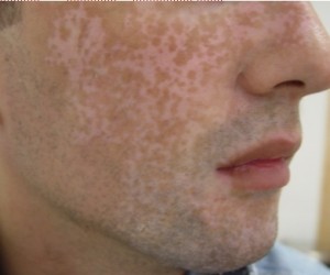  Vitiligo sub tratament = pigmentare peste 80%